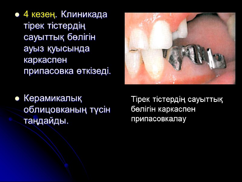 4 кезең. Клиникада тірек тістердің сауыттық бөлігін ауыз қуысында каркаспен припасовка өткізеді.  